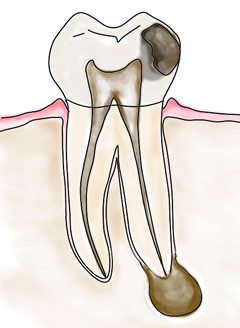 根管治療