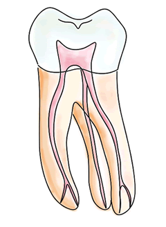 根管治療