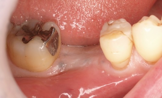 インプラント治療例4-1