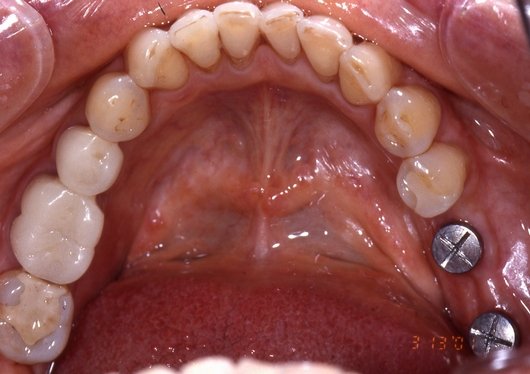 インプラント治療例5-2