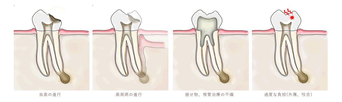 根の病気(根尖病巣)になる原因