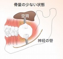 骨造成が必要になる理由