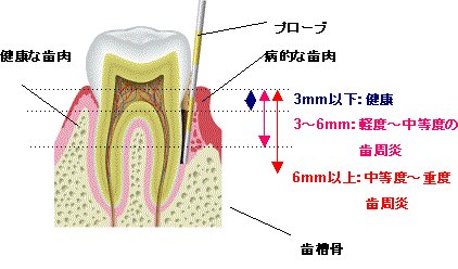 歯周病診査(歯周ポケット測定)