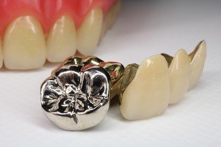 歯科における金属系材料
