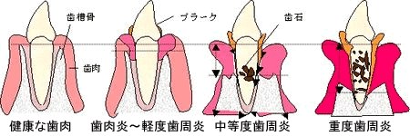 歯周病の進行